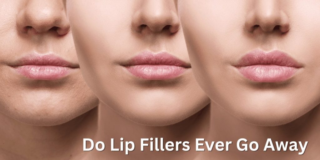 Do Lip Fillers Ever Go Away